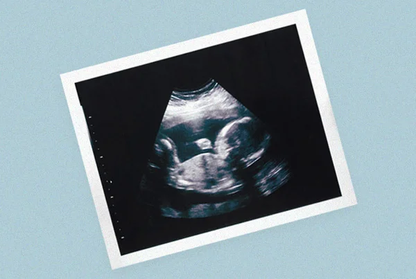 Ultrasound